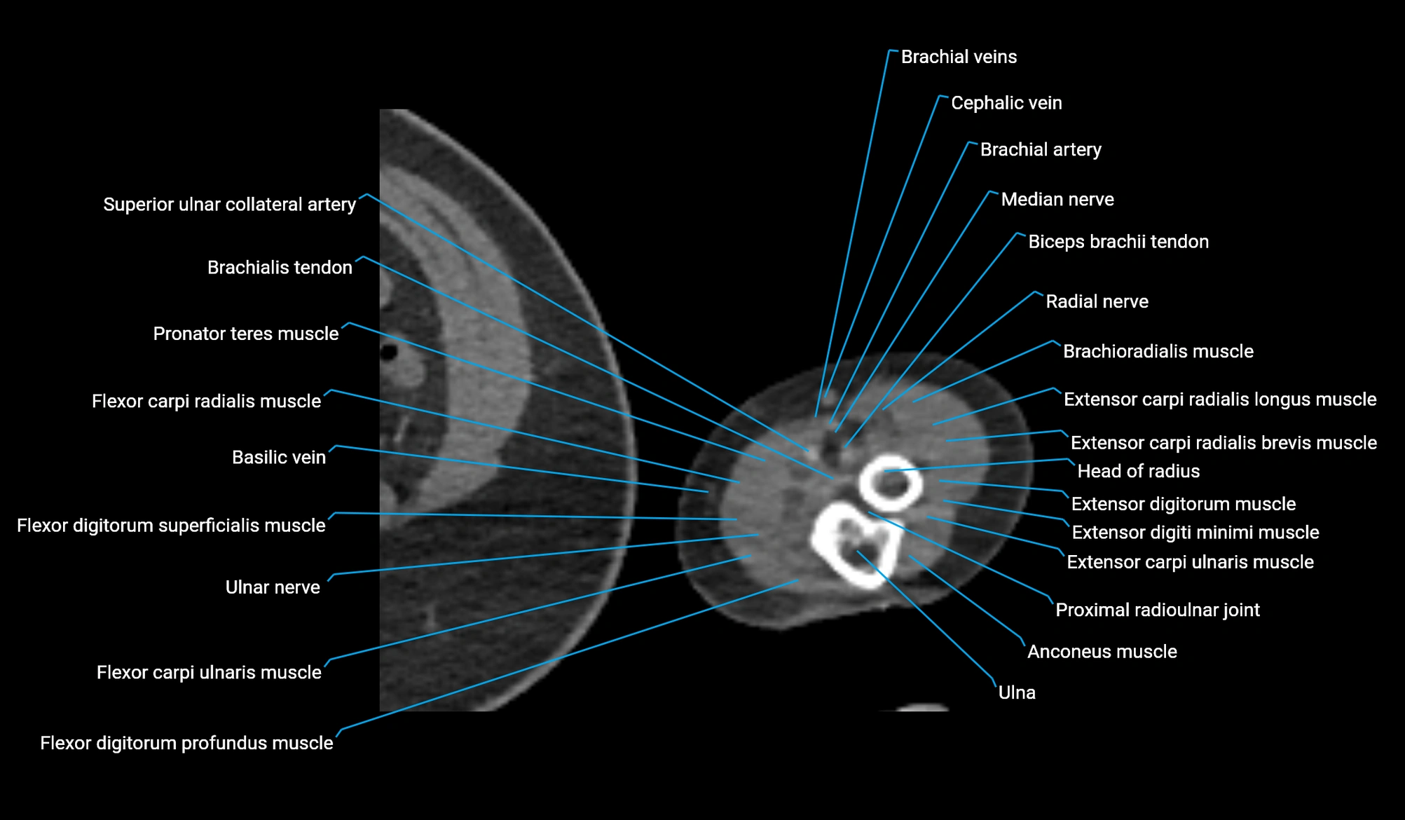 CT upper arm axial  cross sectional anatomy labelled radiology image -00410.webp